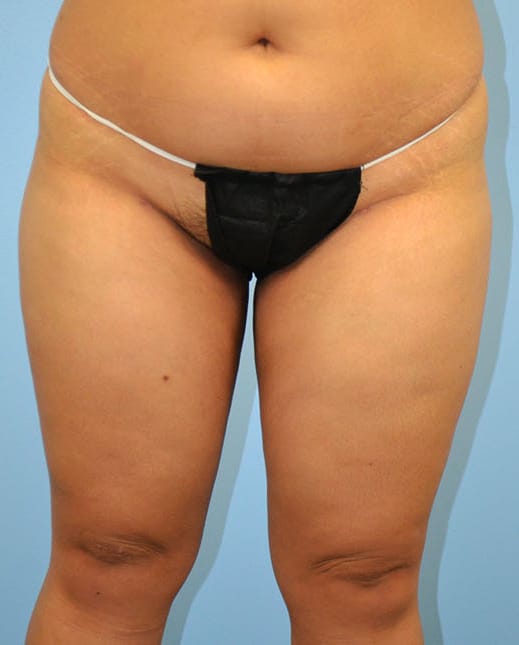 Liposuction after photo - Dr. Cat Beverly Hills