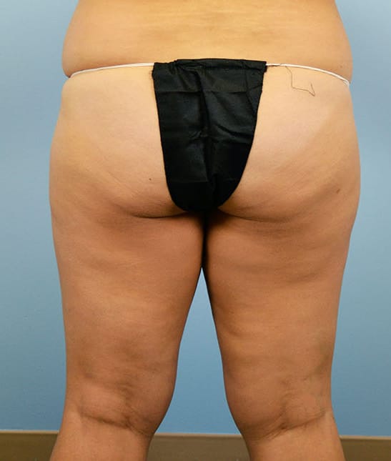 Liposuction before photo - Dr. Cat Beverly Hills
