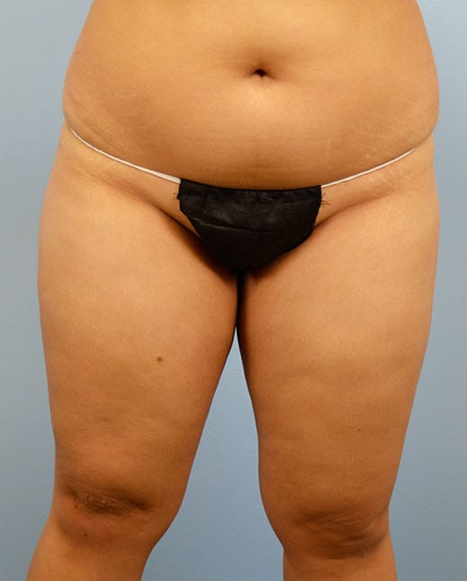 Liposuction before photo - Dr. Cat Beverly Hills
