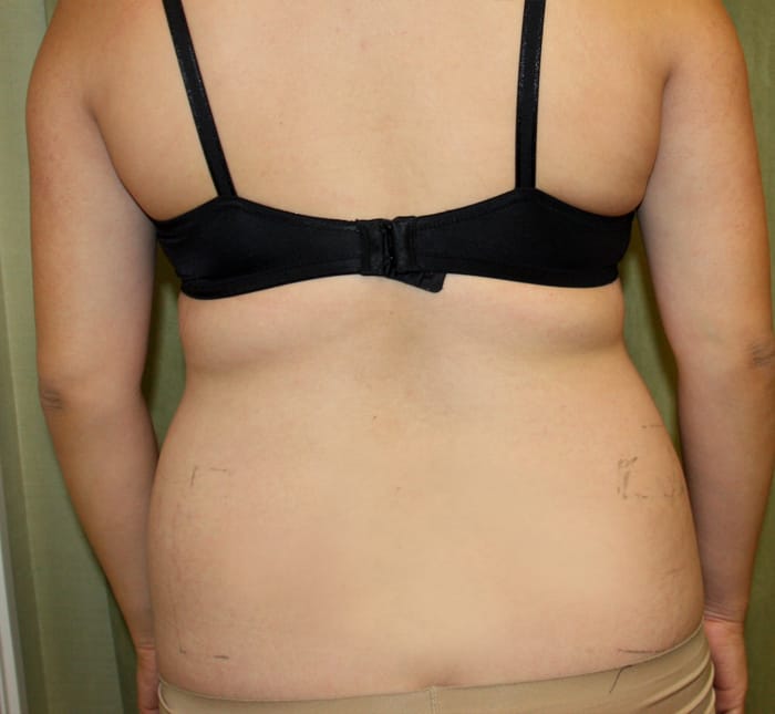 Liposuction before photo - Dr. Cat Beverly Hills