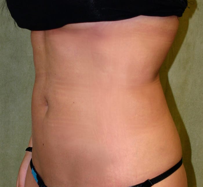 Liposuction after photo - Dr. Cat Beverly Hills