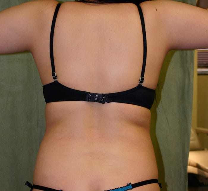 Liposuction before photo - Dr. Cat Beverly Hills