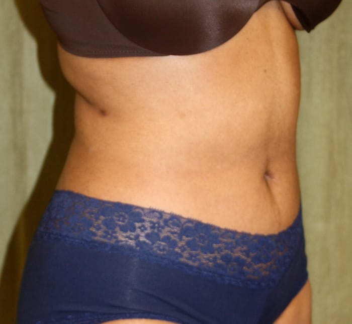 Liposuction after photo - Dr. Cat Beverly Hills