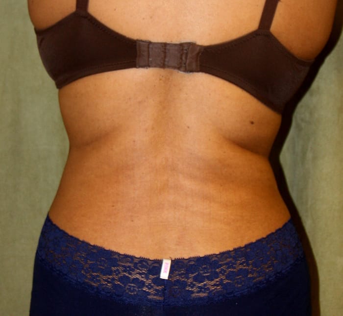 Liposuction after photo - Dr. Cat Beverly Hills
