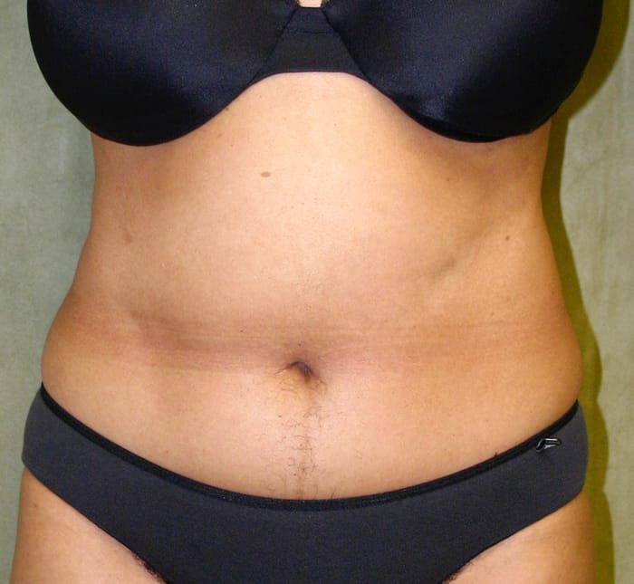 Liposuction before photo - Dr. Cat Beverly Hills