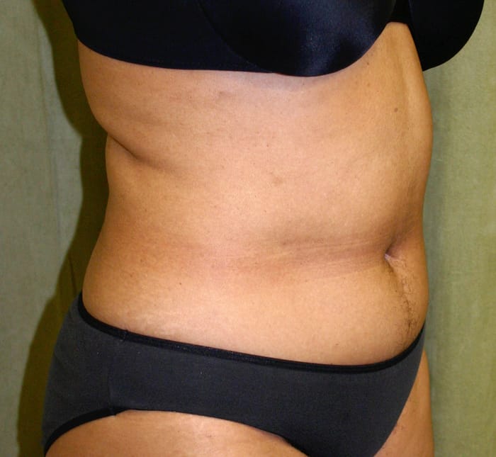 Liposuction before photo - Dr. Cat Beverly Hills