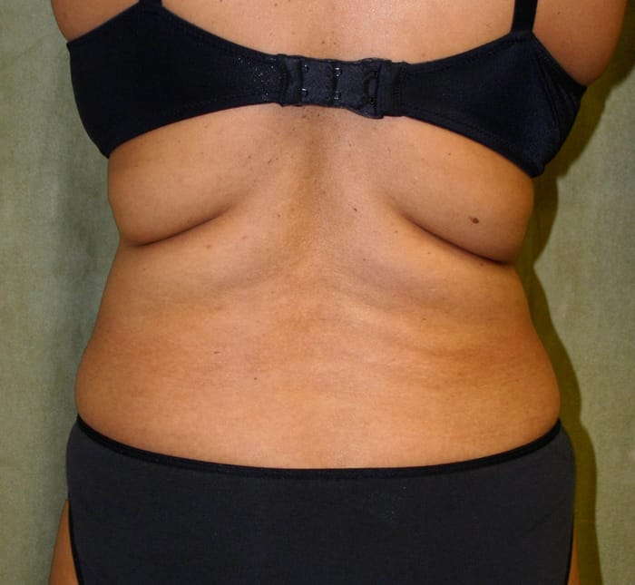 Liposuction before photo - Dr. Cat Beverly Hills