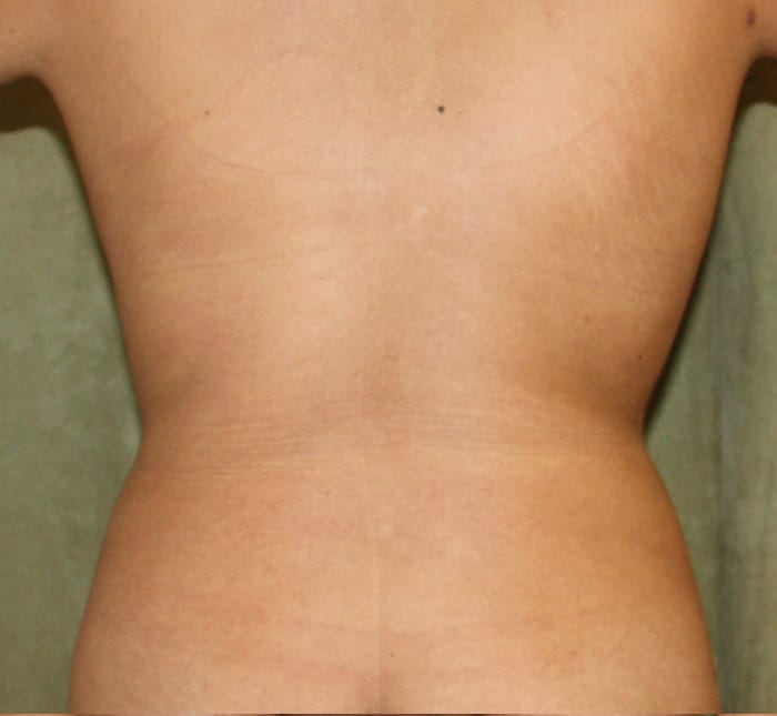 Liposuction after photo - Dr. Cat Beverly Hills