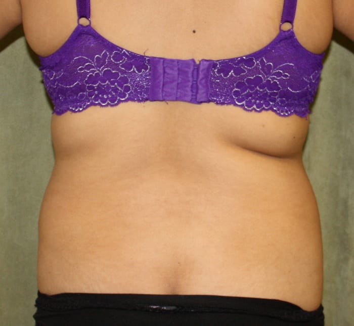 Liposuction before photo - Dr. Cat Beverly Hills