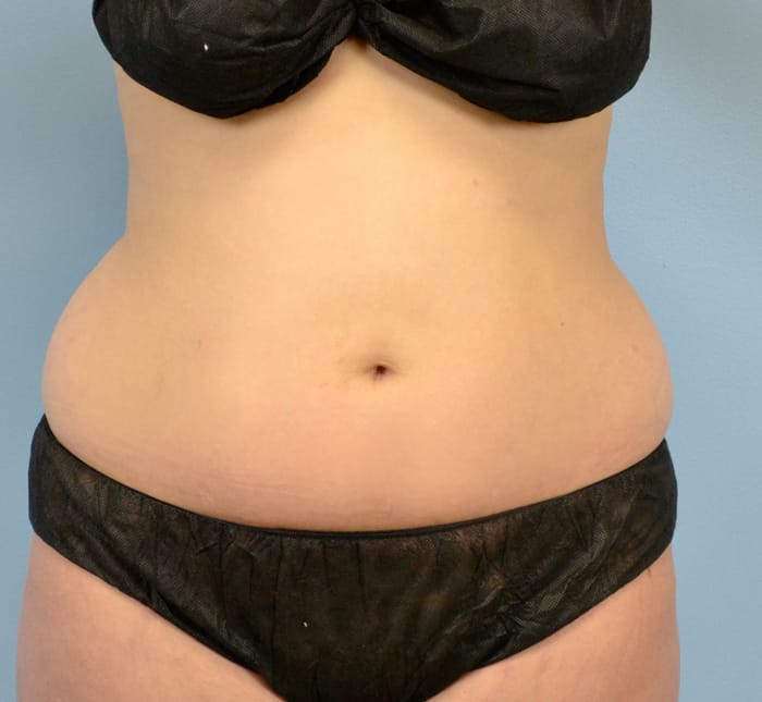 Liposuction before photo - Dr. Cat Beverly Hills