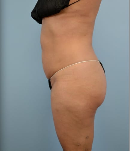 Liposuction after photo - Dr. Cat Beverly Hills