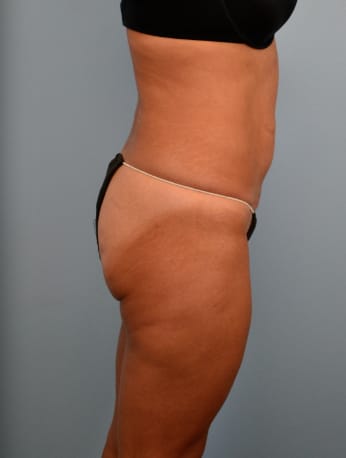 Liposuction after photo - Dr. Cat Beverly Hills