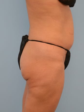 Liposuction before photo - Dr. Cat Beverly Hills