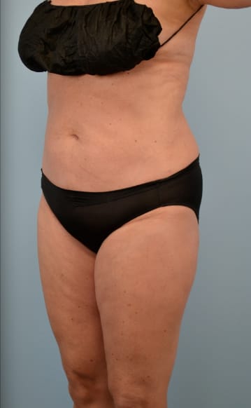 Liposuction after photo - Dr. Cat Beverly Hills