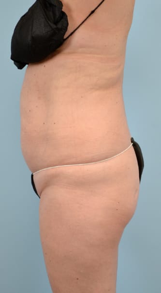 Liposuction before photo - Dr. Cat Beverly Hills