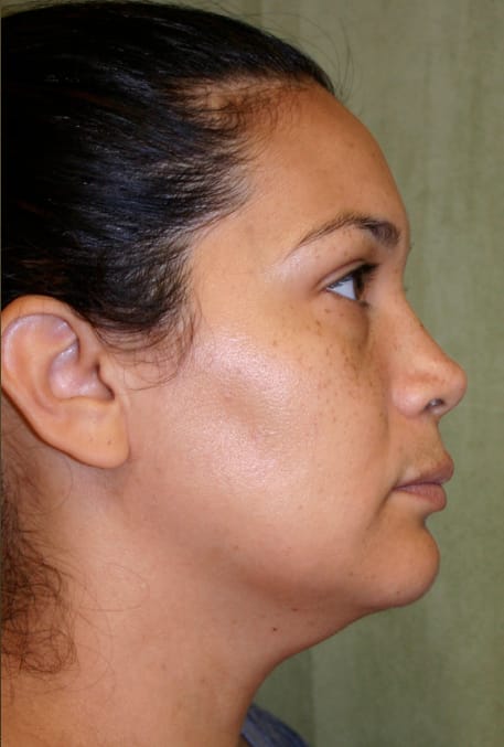 Liposuction after photo - Dr. Cat Beverly Hills