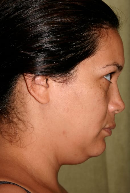 Liposuction before photo - Dr. Cat Beverly Hills