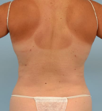 Liposuction after photo - Dr. Cat Beverly Hills