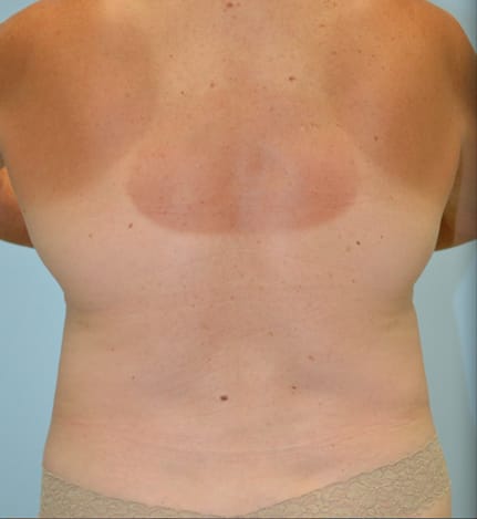 Liposuction before photo - Dr. Cat Beverly Hills