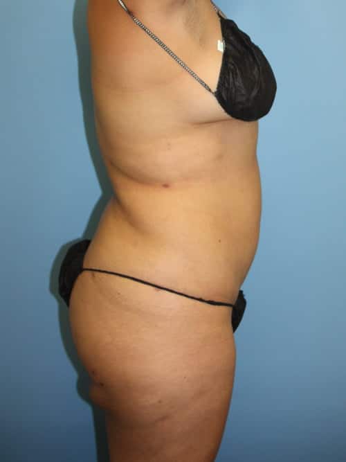 Liposuction after photo - Dr. Cat Beverly Hills