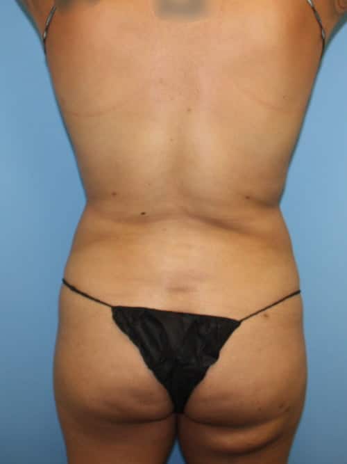 Liposuction after photo - Dr. Cat Beverly Hills