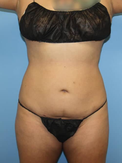Liposuction after photo - Dr. Cat Beverly Hills