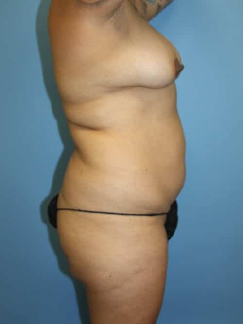 Liposuction before photo - Dr. Cat Beverly Hills