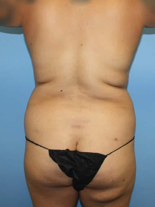 Liposuction before photo - Dr. Cat Beverly Hills