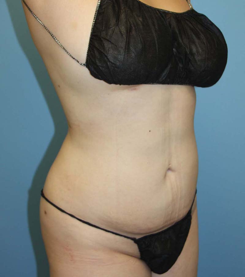 Liposuction after photo - Dr. Cat Beverly Hills