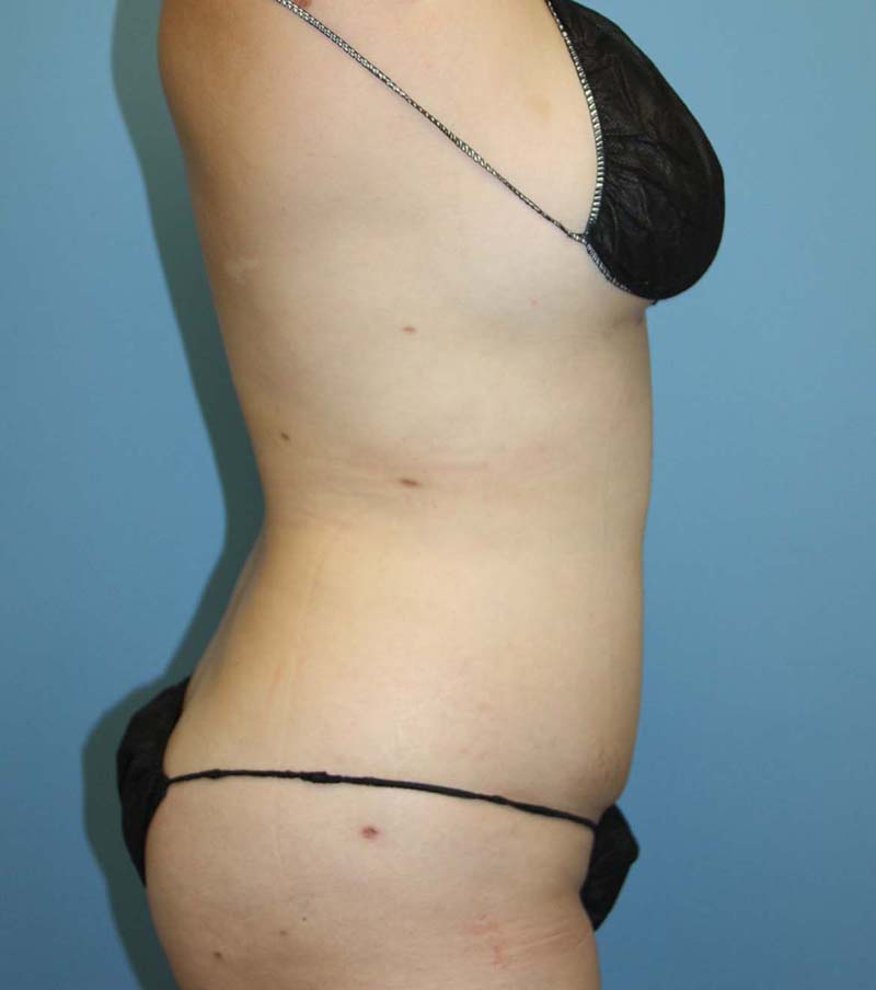 Liposuction after photo - Dr. Cat Beverly Hills