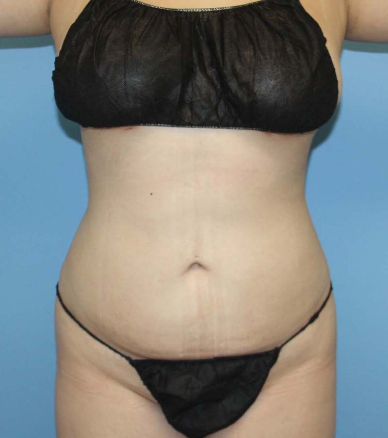 Liposuction after photo - Dr. Cat Beverly Hills