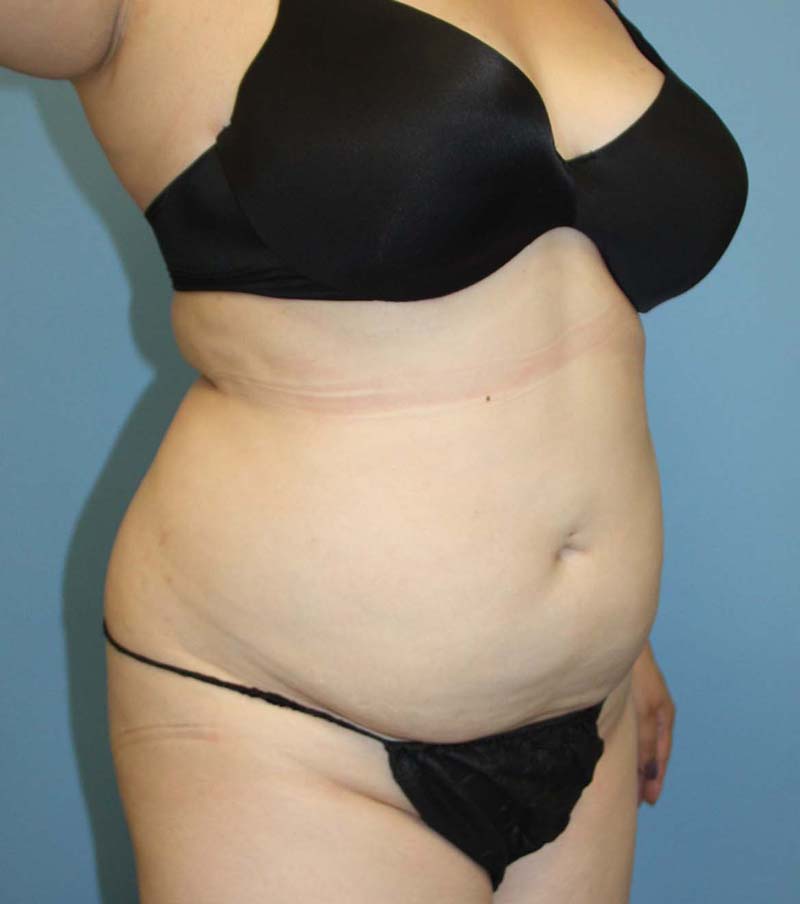 Liposuction before photo - Dr. Cat Beverly Hills