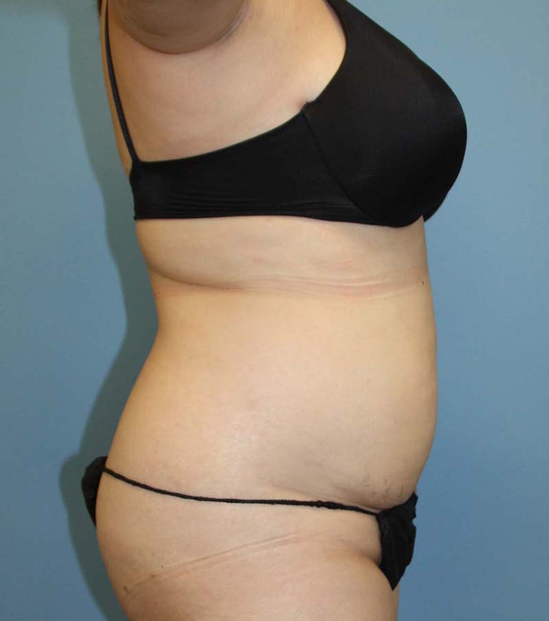 Liposuction before photo - Dr. Cat Beverly Hills