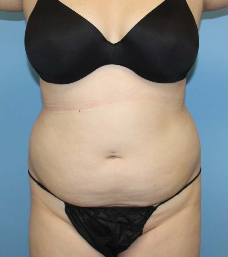 Liposuction before photo - Dr. Cat Beverly Hills