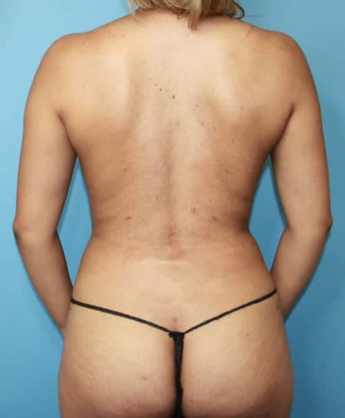 Liposuction after photo - Dr. Cat Beverly Hills
