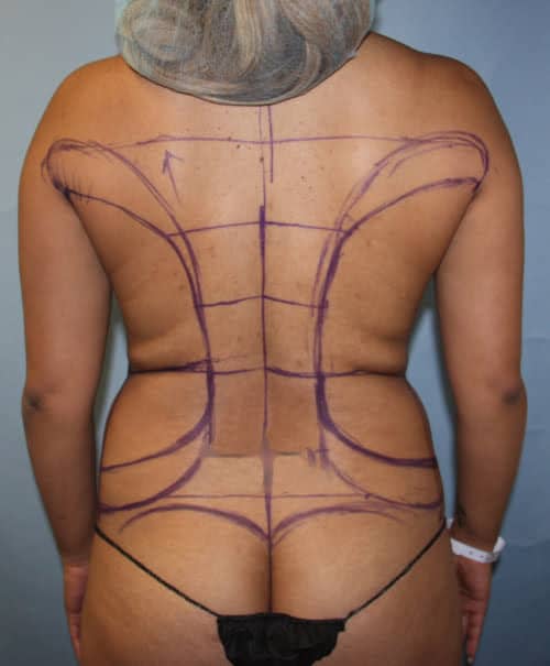 Liposuction before photo - Dr. Cat Beverly Hills