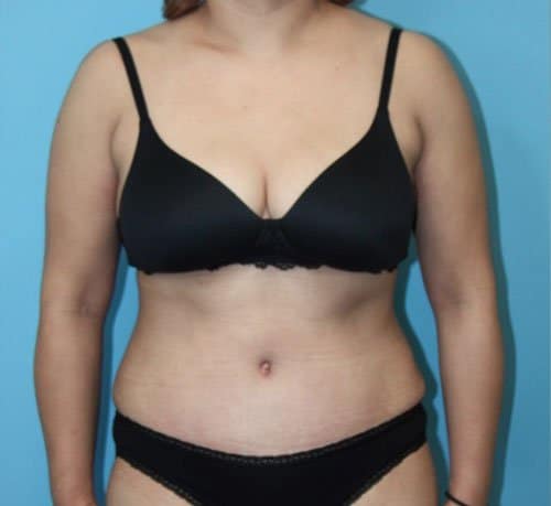Plastic surgery patient after photo - Dr. Cat Beverly Hills