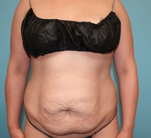 Plastic surgery patient before photo - Dr. Cat Beverly Hills