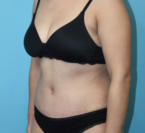 Plastic surgery patient after photo - Dr. Cat Beverly Hills