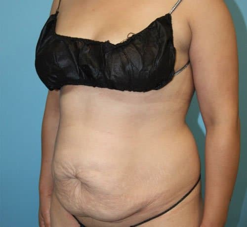 Plastic surgery patient before photo - Dr. Cat Beverly Hills