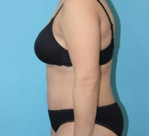 Plastic surgery patient after photo - Dr. Cat Beverly Hills