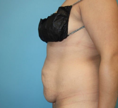 Plastic surgery patient before photo - Dr. Cat Beverly Hills