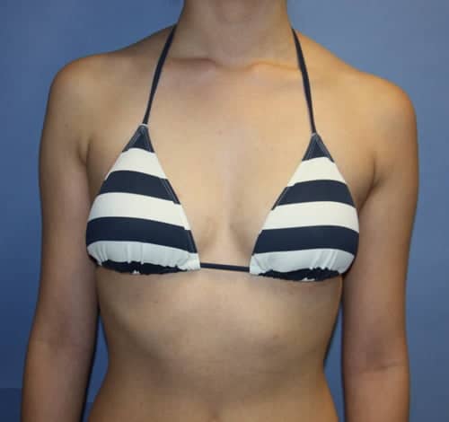 Breast Surgery before photo front view - Dr. Cat Beverly Hills