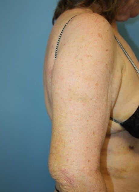 Revision Liposuction before photo side view - Dr. Cat Beverly Hills