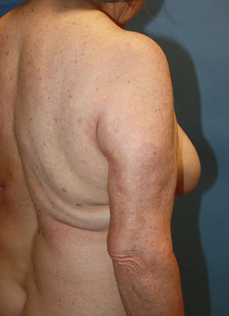 Revision Liposuction after photo side view - Dr. Cat Beverly Hills