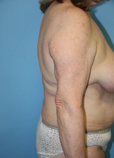 Revision Liposuction before photo side view - Dr. Cat Beverly Hills