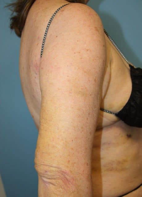 Revision Liposuction after photo side view - Dr. Cat Beverly Hills