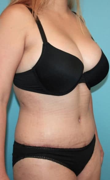 Tummy Tuck after photo side view - Dr. Cat Beverly Hills