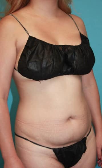 Tummy Tuck before photo side view - Dr. Cat Beverly Hills