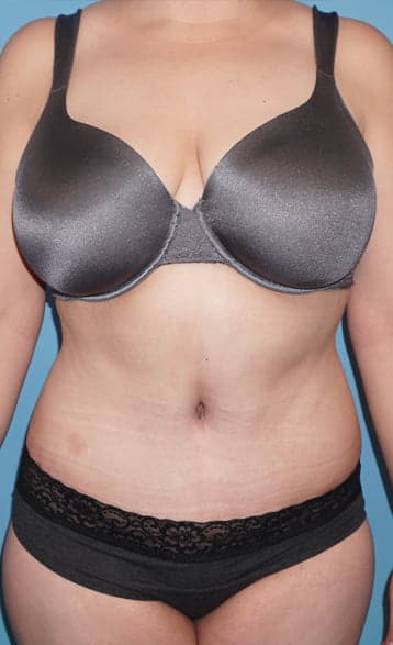 Tummy Tuck after photo front view - Dr. Cat Beverly Hills